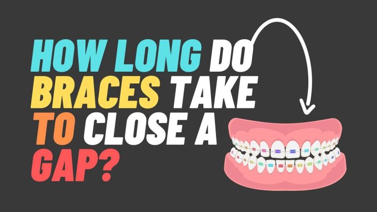 How Long Do Braces Take To Close a Gap | Easy Way